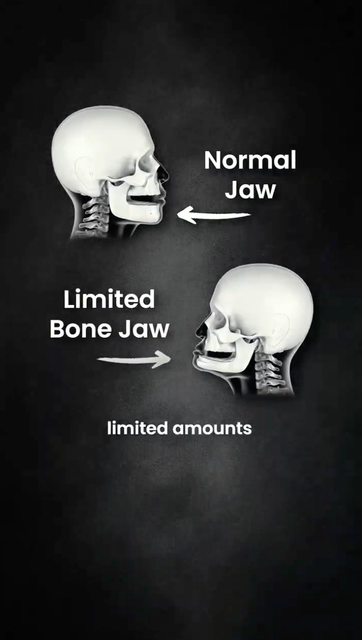 What are pterygoid implants